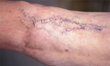 Μέθοδοι για τη θεραπεία των κιρσών στα πόδια