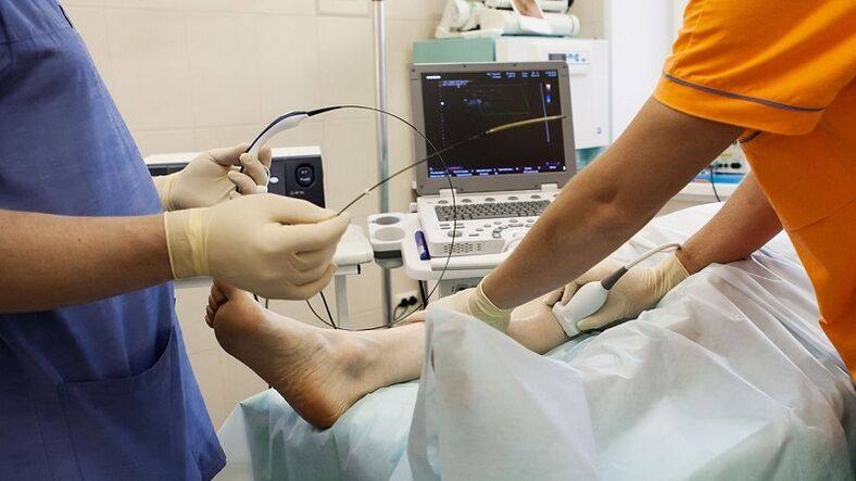 Χειρουργική επέμβαση αφαίρεσης κιρσών